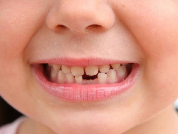 Mộng thấy rụng răng hàm dưới